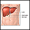 Liver transplant
