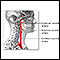 Carotid artery surgery