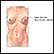 Breast reconstruction - series