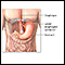 Gastroesophageal reflux - Series