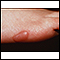 Keloid, on the foot