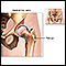 Hip joint replacement - Series