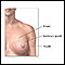Breast lump removal - Series