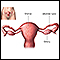 Tubal ligation - Series